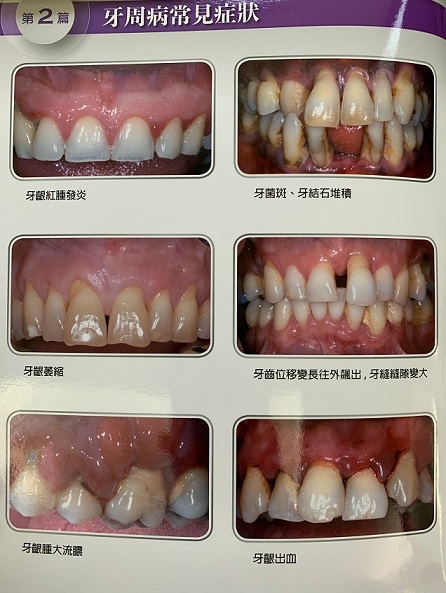 牙周病會好嗎？牙周病常見六大症狀